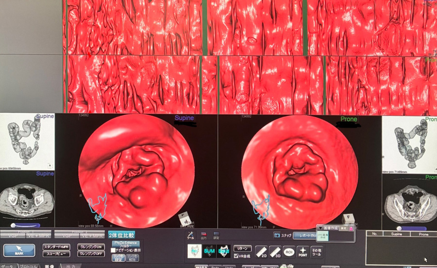 大腸の新しい検査法